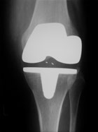 knie-nach-doppelschlitten- Dr. med. Konrad Scheuerer Orthopäde Unfallchirurgie München