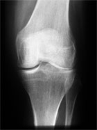 kniegelenk-mit-arthrose - Dr. med. Konrad Scheuerer Orthopäde Unfallchirurgie München