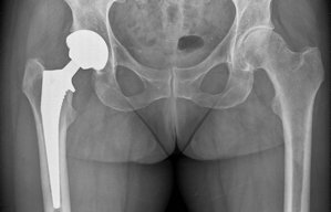 Yale Hüfte OP nachher Orthopäde. Orthopädie Unfallchirurgie in 80803 München