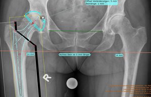 Yale Hüfte OP Planung Orthopäde. Orthopädie Unfallchirurgie in 80803 München