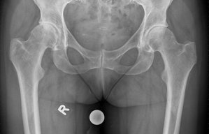 Yale Hüfte OP vorher Orthopäde. Orthopädie Unfallchirurgie in München